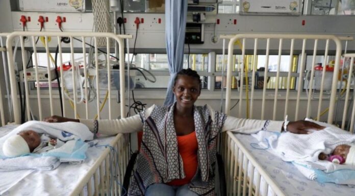 Conjoined Twins Separated Successfully In Cape Town South Africa Sapeople Worldwide South 2904